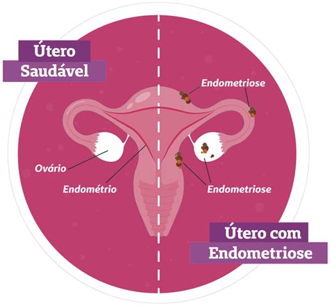 quais sintomas da endometriose